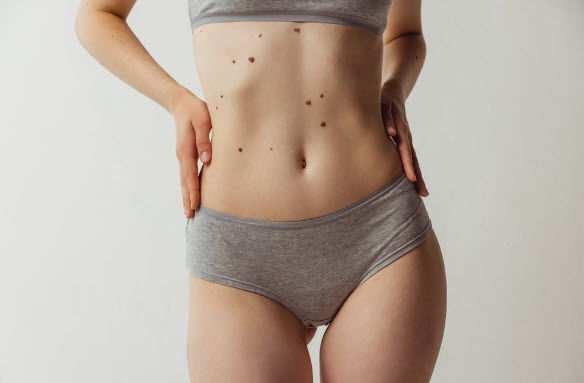 Nốt ruồi sau gáy phụ nữ và những diễn giải dân gian phổ biến