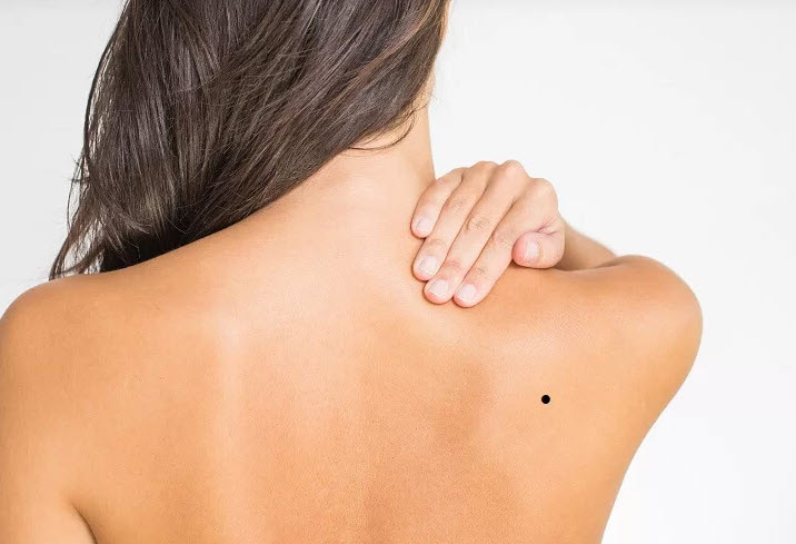 Nốt ruồi trên cơ thể: cổ, vai, ngực, bụng, lưng