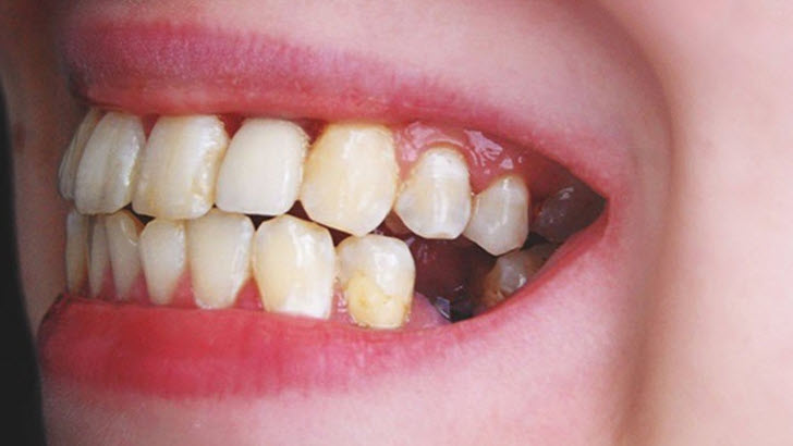 nằm mơ thấy rụng răng