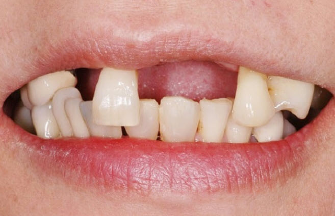 nằm mơ thấy rụng răng