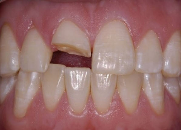 ý nghĩa giấc mơ rụng nhiều răng không chảy máu: chuyển hóa êm