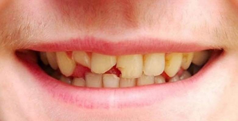 Nằm Mơ Bị Mẻ Răng Báo Hiệu Điều Gì