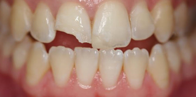 Nằm Mơ Bị Mẻ Răng Báo Hiệu Điều Gì